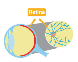 Retinopatía diabética