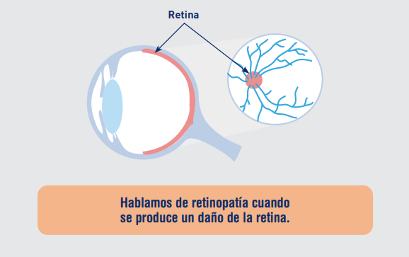 daño en la retina